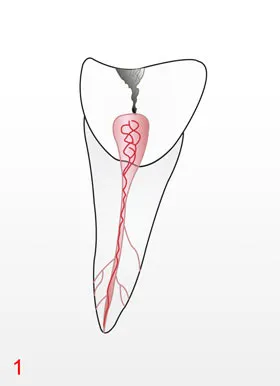 Endodontie-Behandlung in der Zahnarztpraxis Laatzen