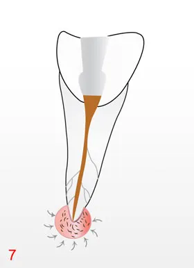 Endodontie-Behandlung in der Zahnarztpraxis Laatzen
