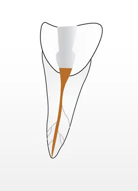 Endodontie-Behandlung in der Zahnarztpraxis Laatzen